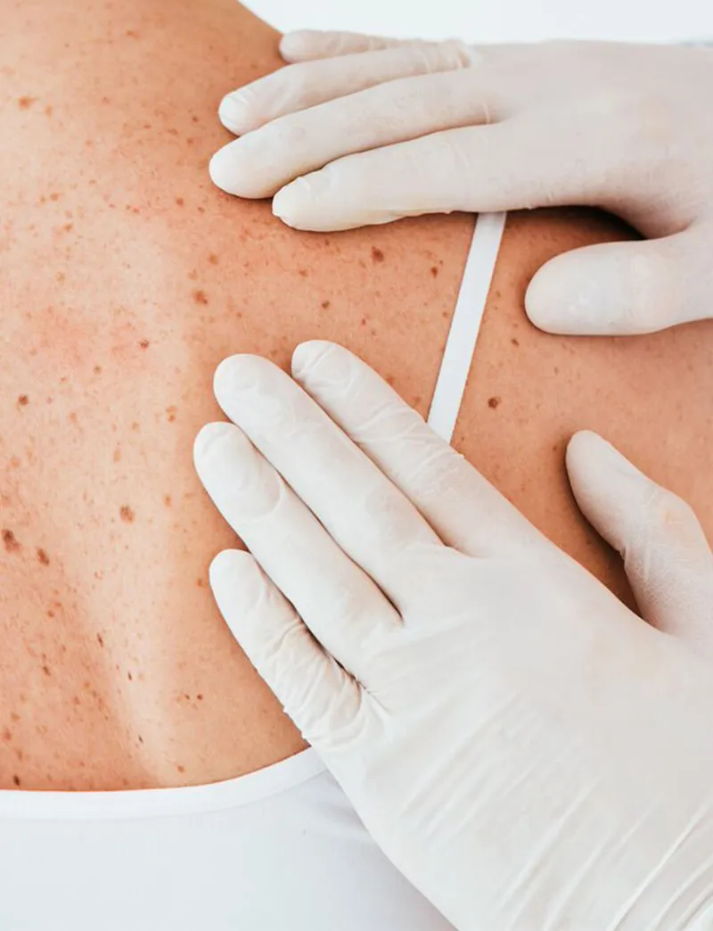 Keratosis Removal