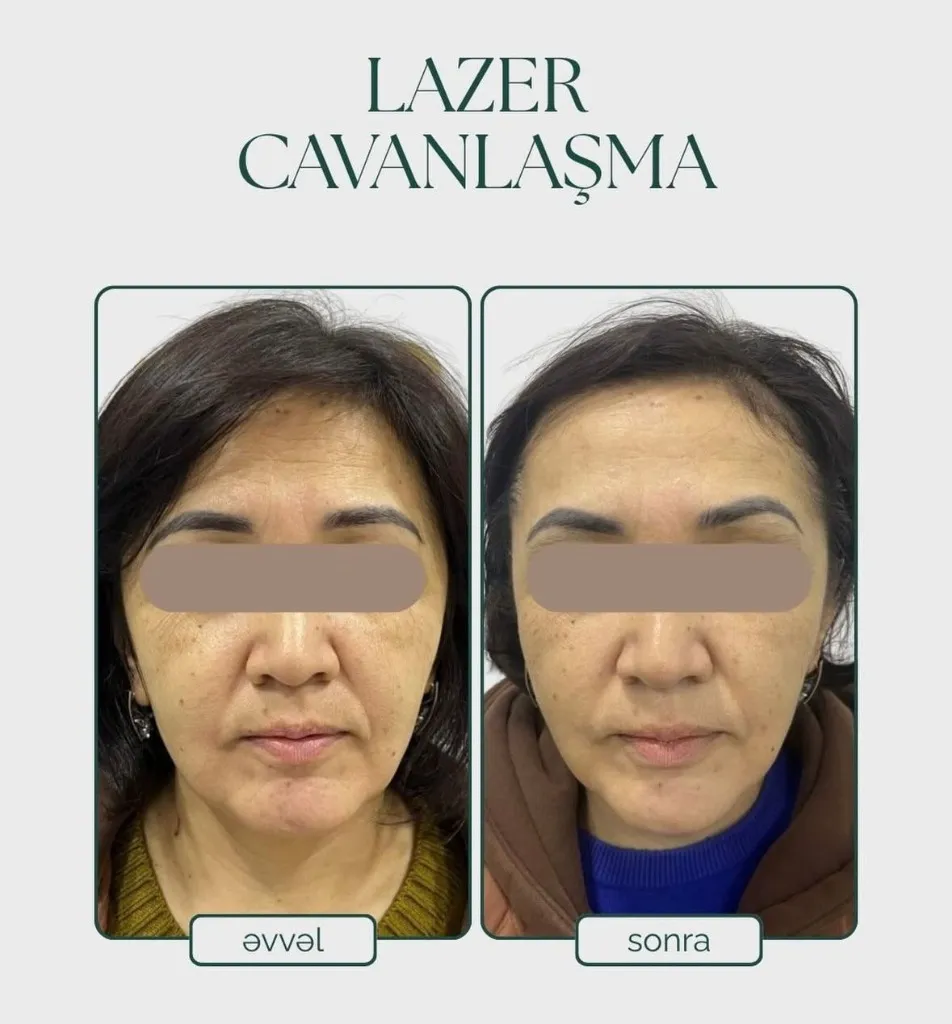 Laser Rejuvenation