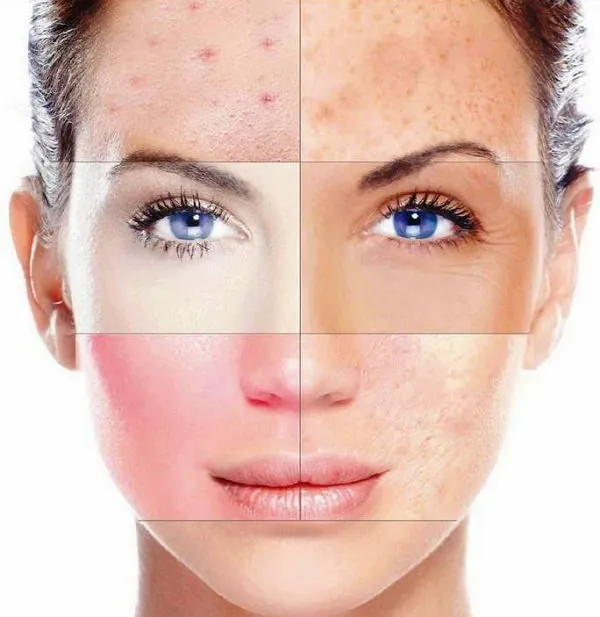 Pigment Spot Removal