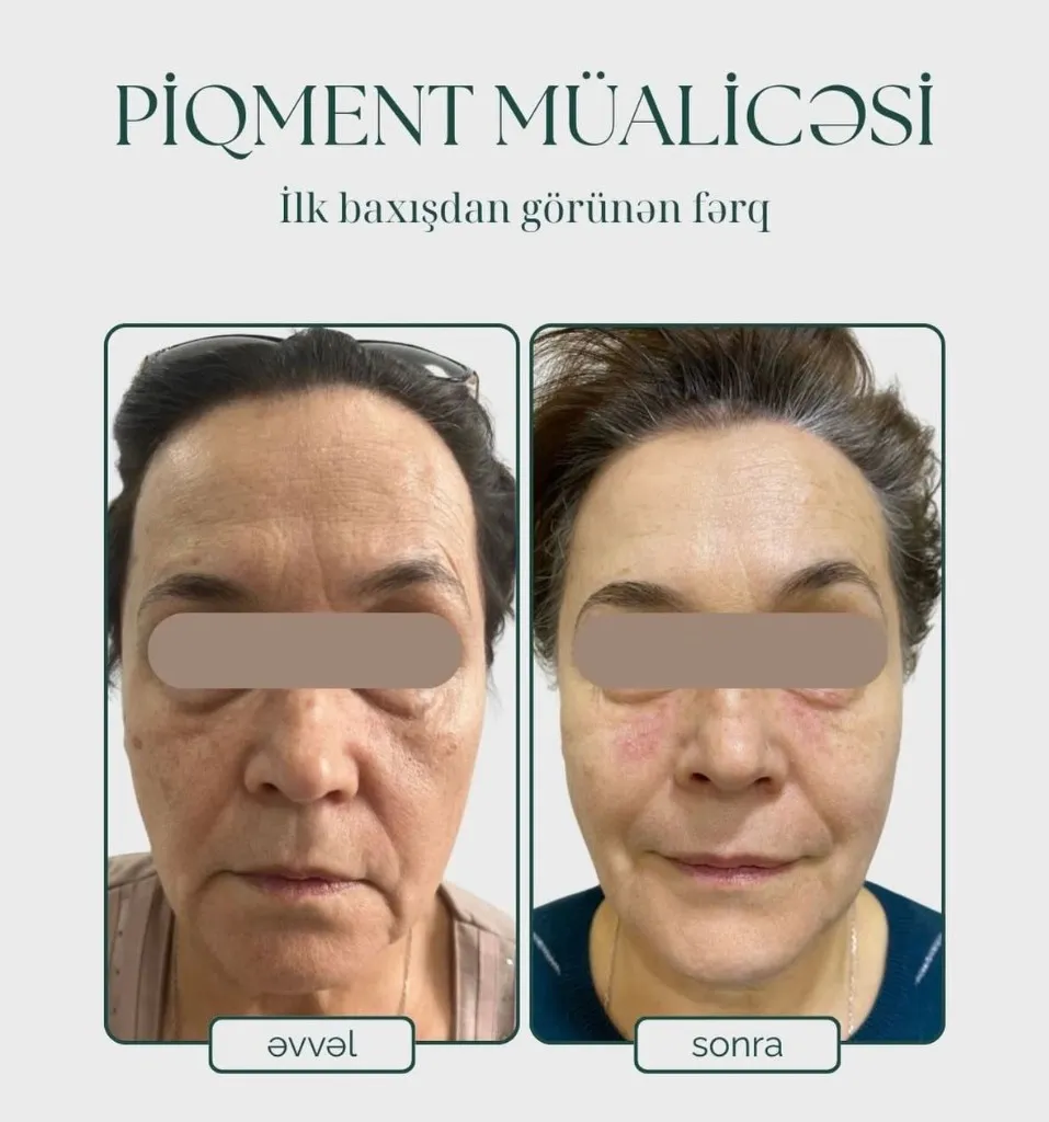 Pigment Treatment