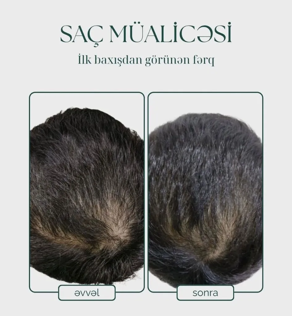 Hair Treatment