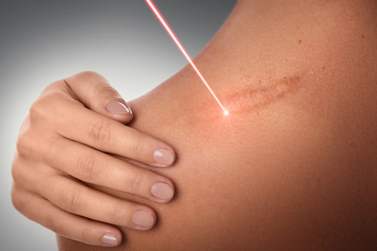 SCAR REMOVAL WITH CO₂ LASER