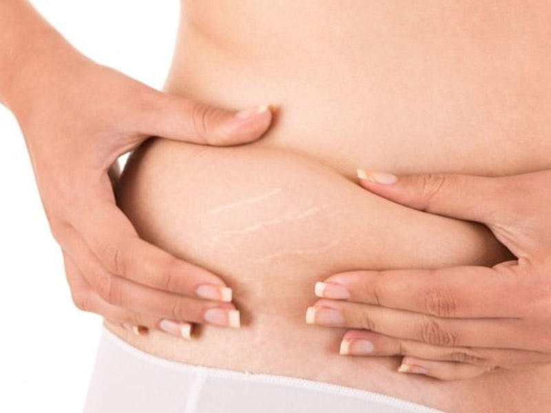 STRETCH MARK TREATMENT