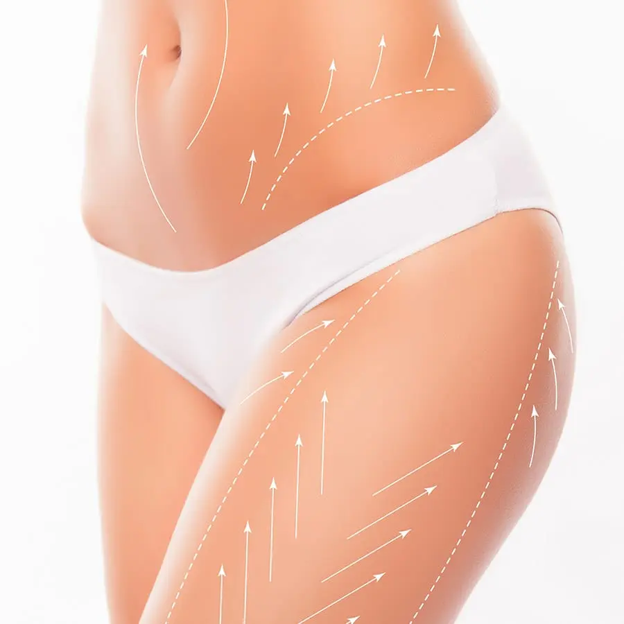 VSHAPE BODY TREATMENT (RF + VACUUM + INFRARED)